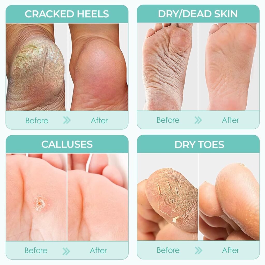 DERMORA Foot Peel Mask - 2 Pack, Regular Size Skin Exfoliating Foot Masks for Dry, Cracked Feet, Callus, Dead Skin Removal, Soothing, Smooth Skin